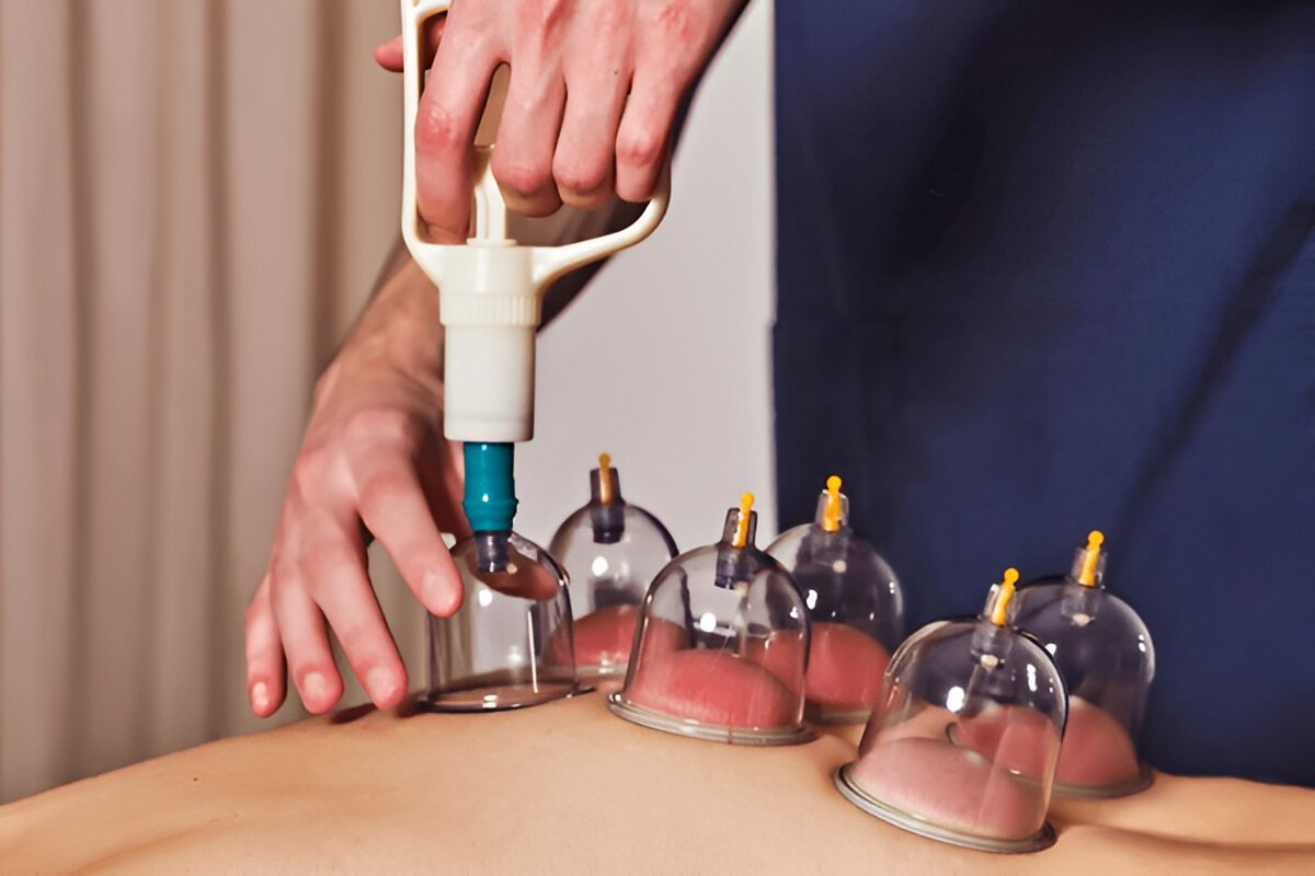 Diploma in Cupping Therapy